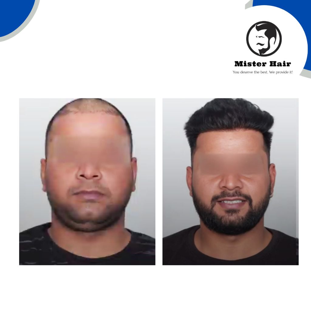 Before After Result 1