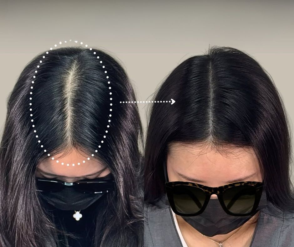 여성 가르마 밀도 보강 전후 비교