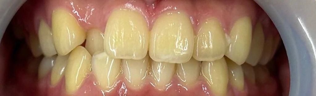 ホワイトニング前