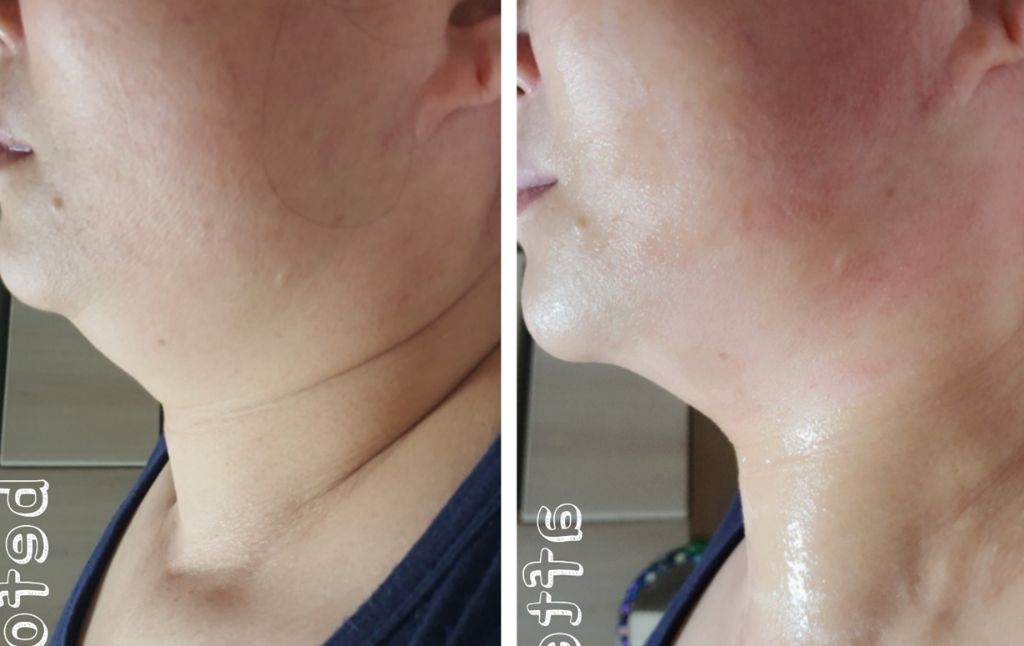 안면 윤곽 개선