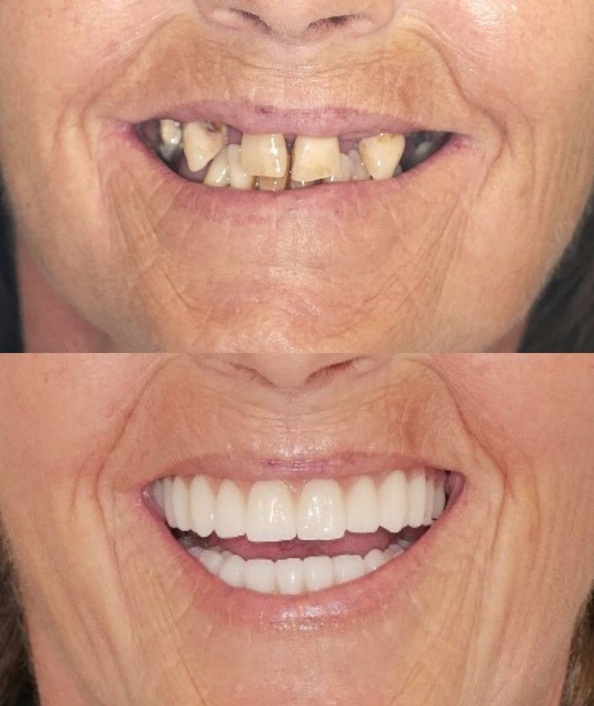 Riabilitazione protesica completa donna - prima e dopo