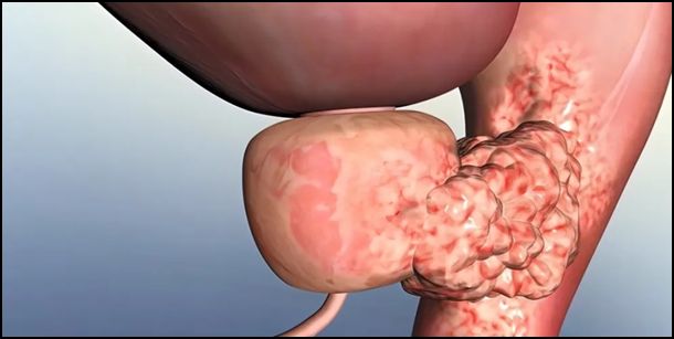 Prostat Hastalıkları ve Etkileri