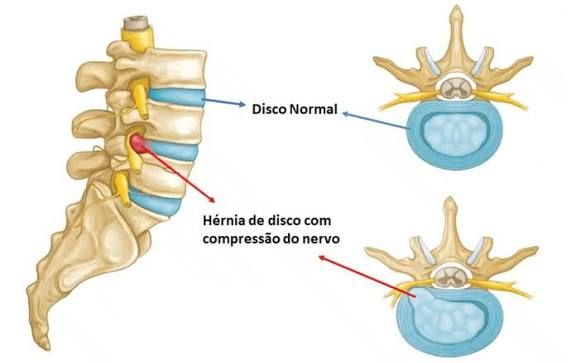 Anatomia: Disco normal vs Hérnia de disco com compressão do nervo