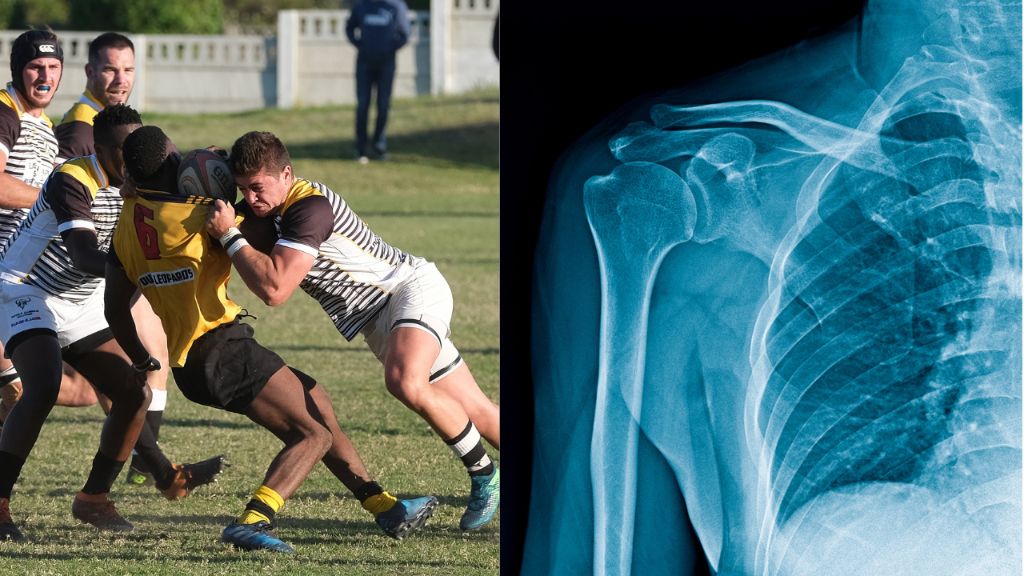 学生時代の骨折