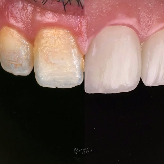 Precision veneers