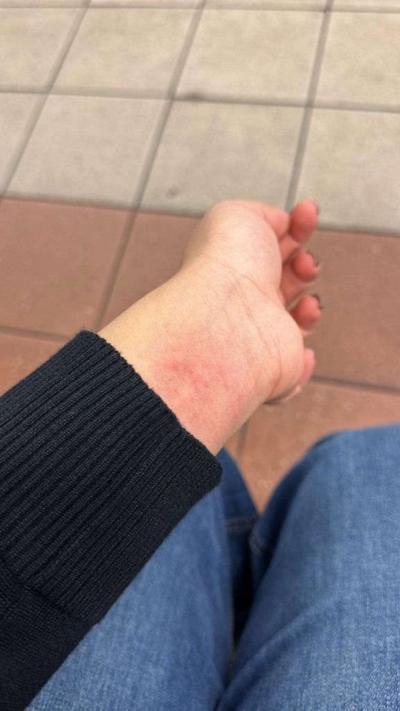 Sumaita's hand, a testament to resilience.