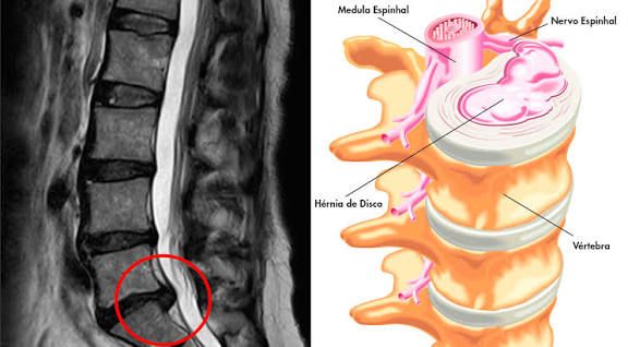 Ressonância magnética mostrando hérnia de disco - Diagnóstico por imagem
