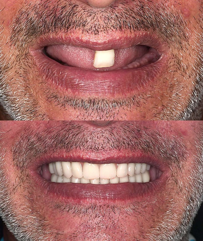 Ricostruzione implantare totale - prima e dopo