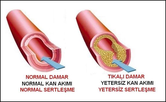 Normal ve Yetersiz Kan Akımı Karşılaştırması