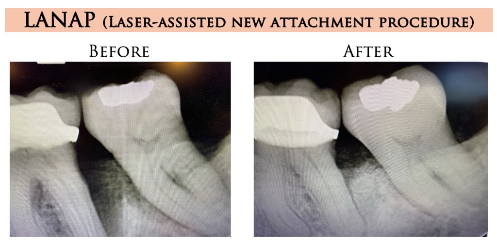 LANAP Before and After Results