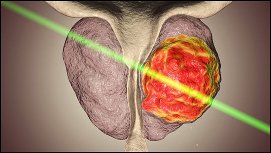 Prostat Tedavi Teknolojisi