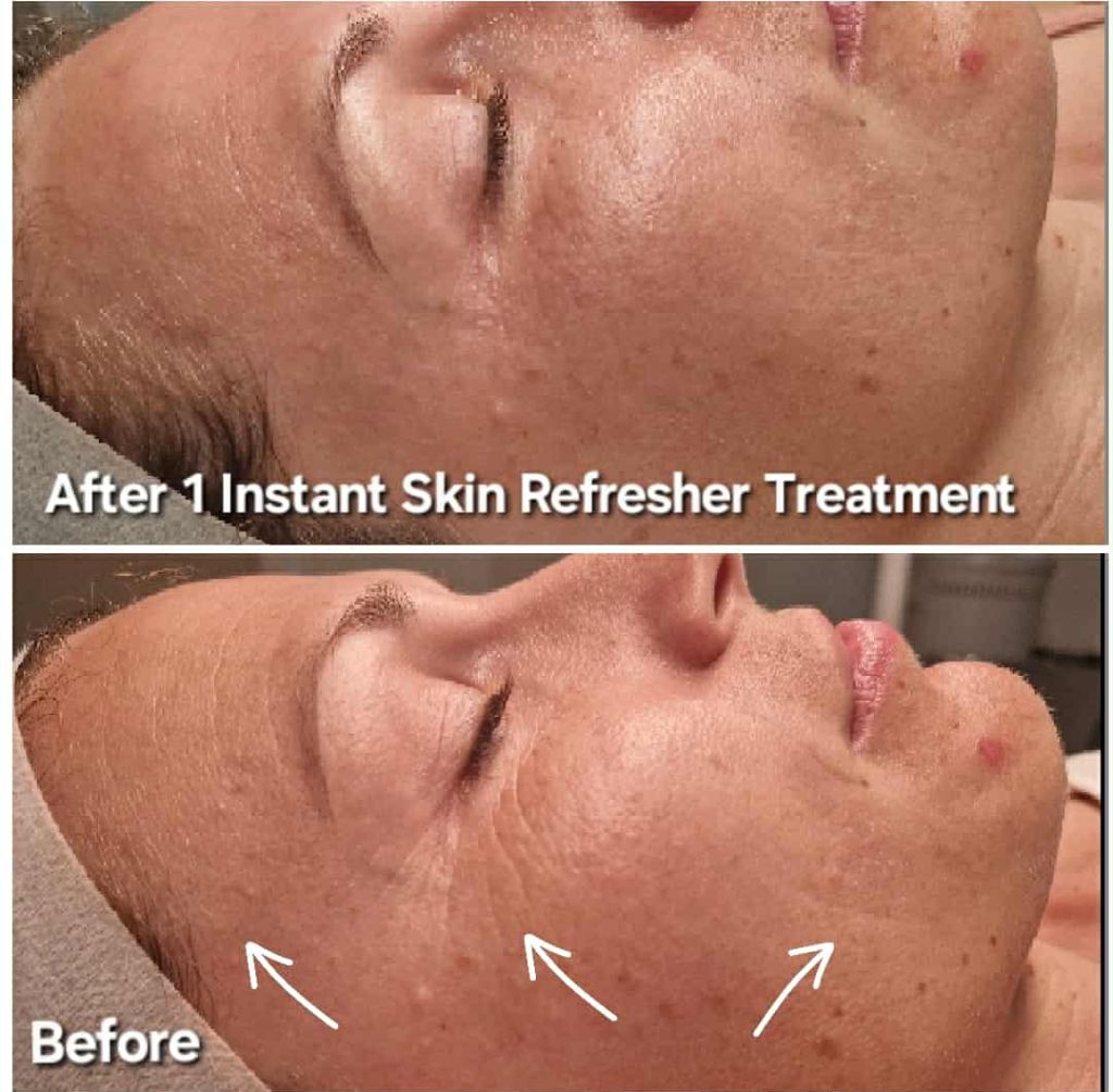 Before and After Instant Skin Refresher Treatment - Showing smoothing and lifting results
