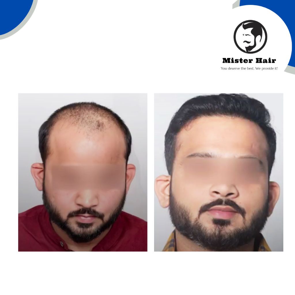 Before After Result 2