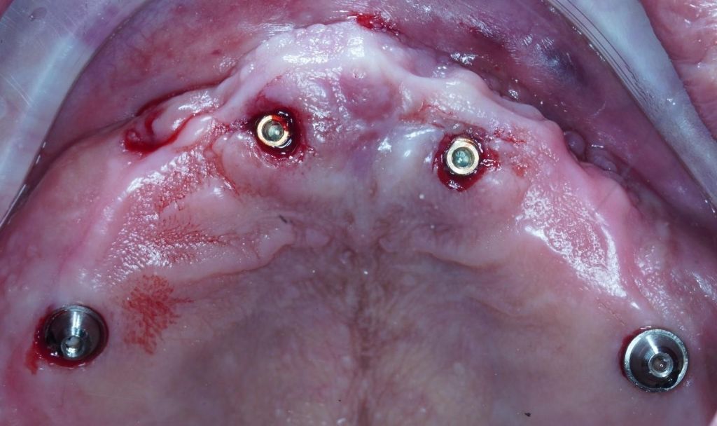 林楚喬醫師微創植牙手術實況