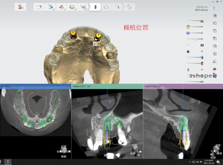 3D導航植牙規劃系統