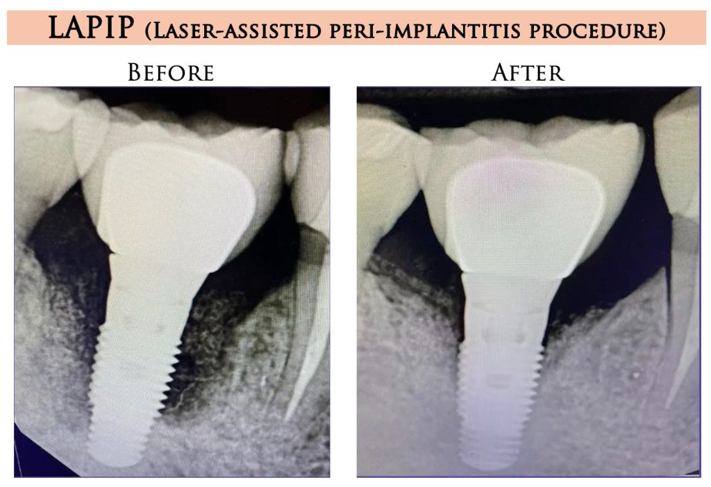 LAPIP Before and After Results